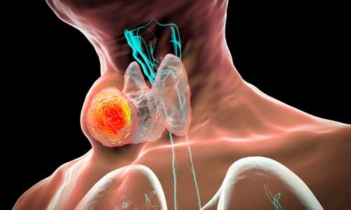 Tiroid Ameliyatlarında Sonra Ne Gibi İstenmeyen Yan Etkiler Ortaya Çıkabilir?