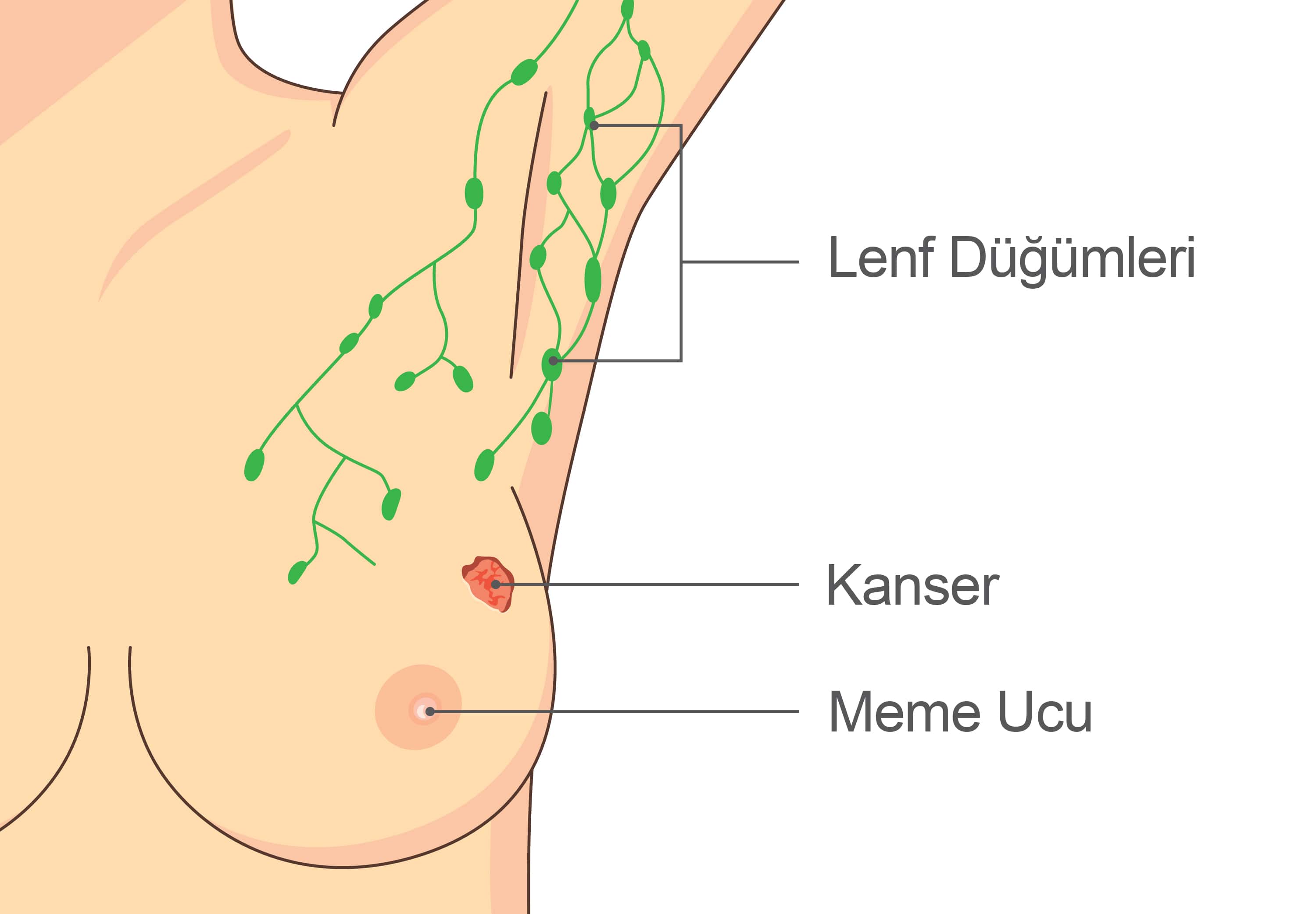 Lenfödem (Kol Şişmesi)